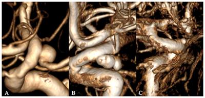 Analysis of the wall thickness of intracranial aneurysms: Can computational fluid dynamics detect the translucent areas of saccular intracranial aneurysms and predict the rupture risk preoperatively?